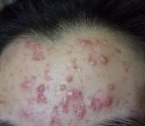 额头上的痘痘像鸡皮疙瘩(额头上的痘痘像鸡皮疙瘩怎么回事)