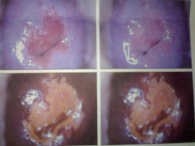  p>炎症通常可依病程经过分为两大类:急性炎症(acute inflammation)和