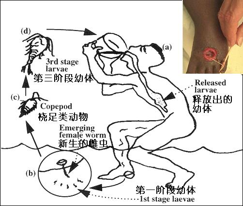 data-id="tspnfohk8cek">麦地那龙线虫病(dracunculosis)又名几内亚