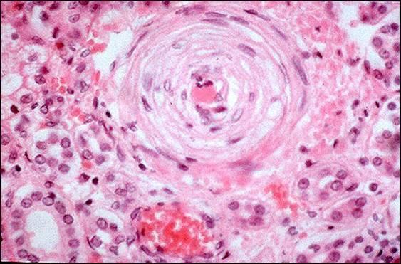 入球小动脉玻璃样变