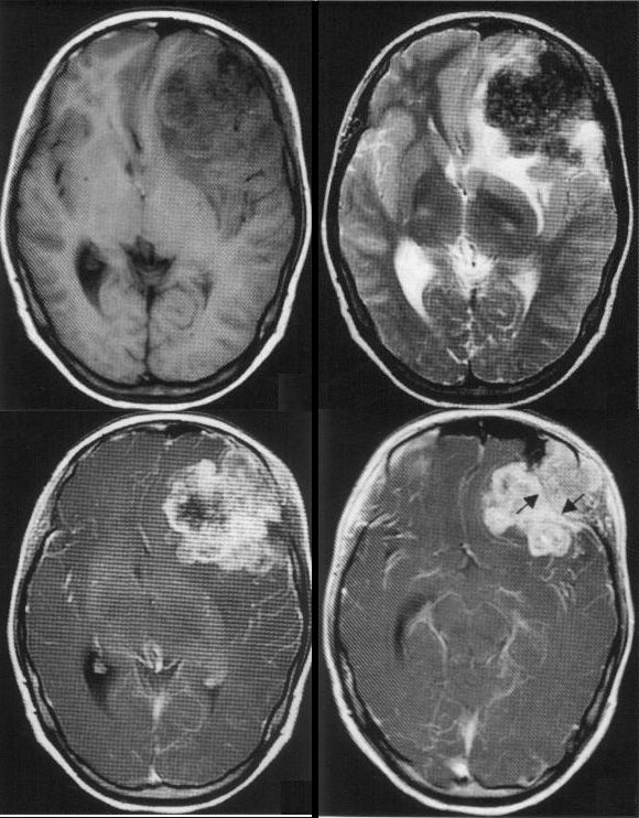 恶性间叶性肿瘤