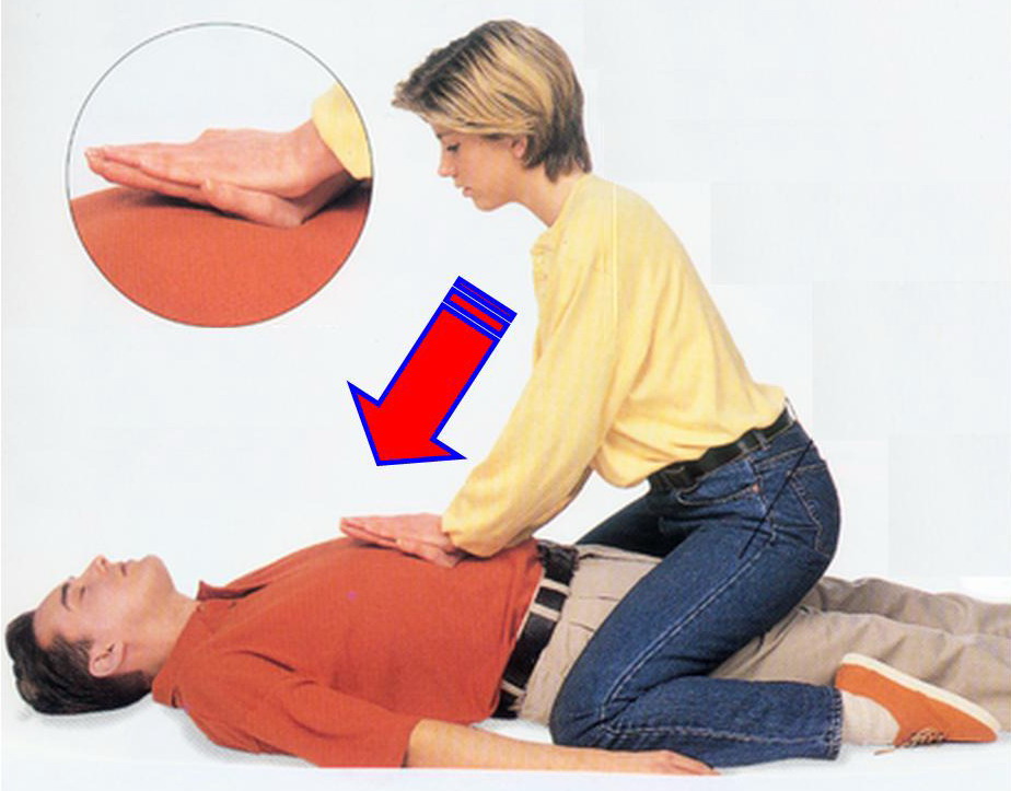 海姆里克腹部冲击法