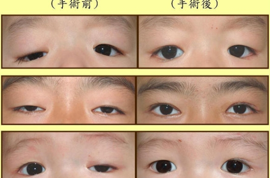  p>上眼睑下垂是一种美容手术,是通过缩短上睑提肌以增强肌力,提高其