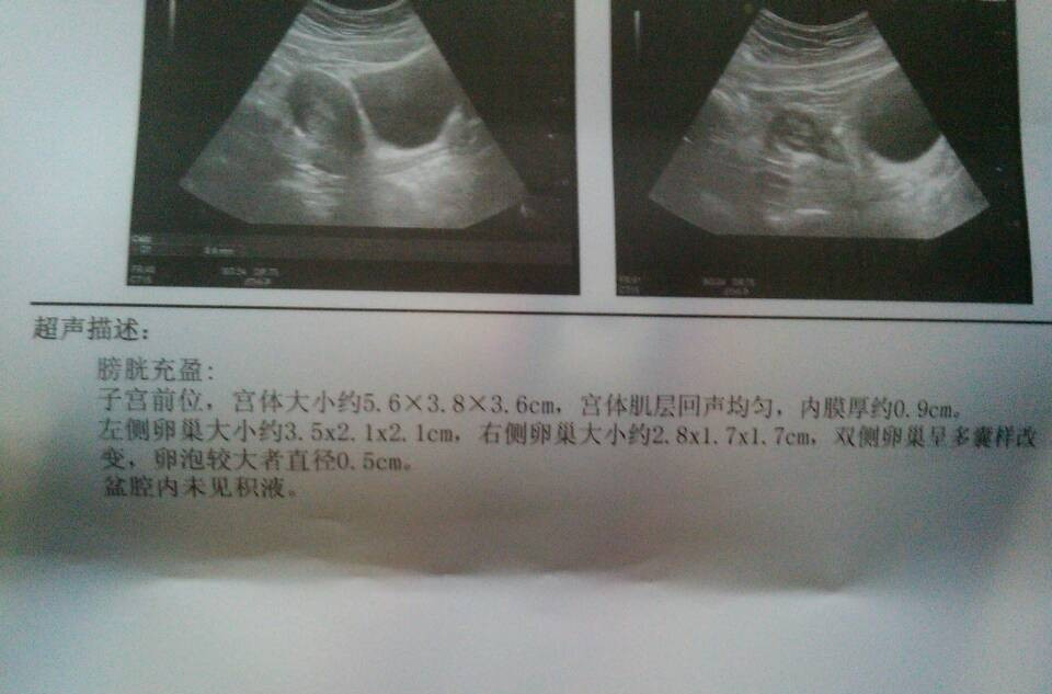 很多女性因为双侧多囊卵巢,导致无法怀孕.