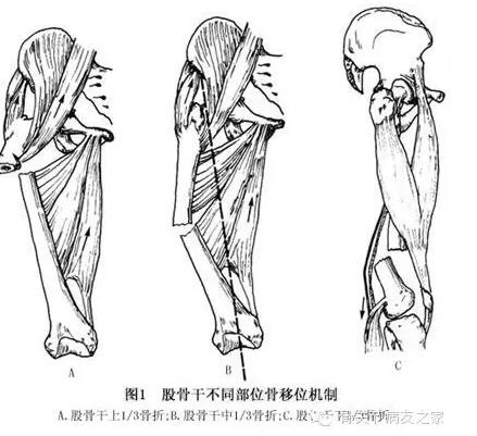 股骨干骨折内固定术