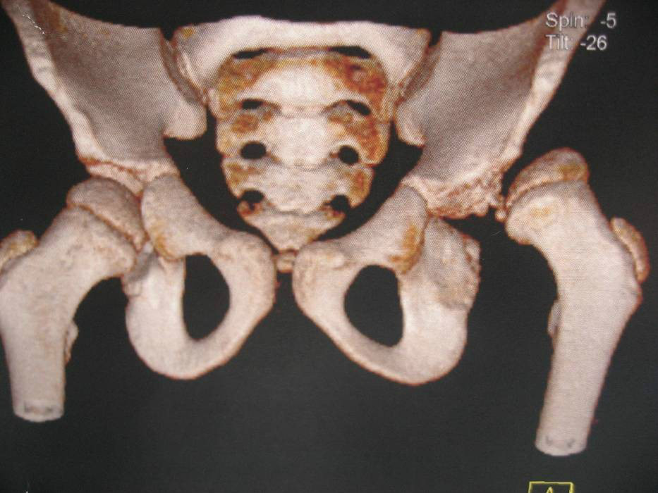 先天髋关节发育不良
