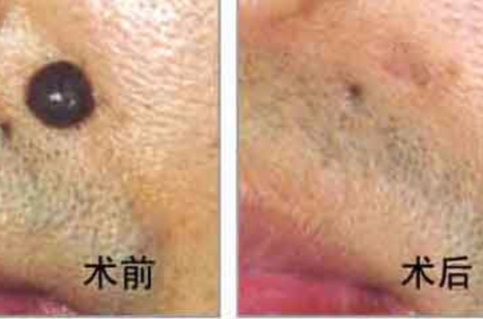点痣激光