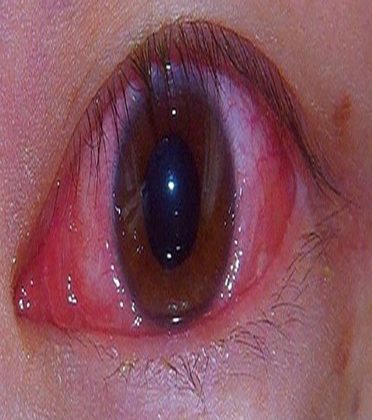  p>慢性结膜炎为由多种原因引起的结膜慢性炎症,其病因包括: a href="