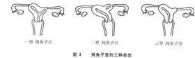 单角或双角子宫_百度百科
