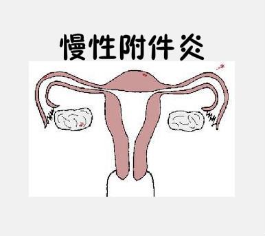 女性附件炎