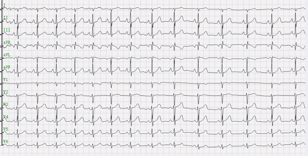 href="/item/动态心电图/811256" data-lemmaid="811256">动态心电图 