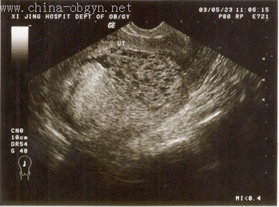  p>胎盘部位滋养细胞肿瘤是指来源于胎盘种植部位的一种特殊类型的