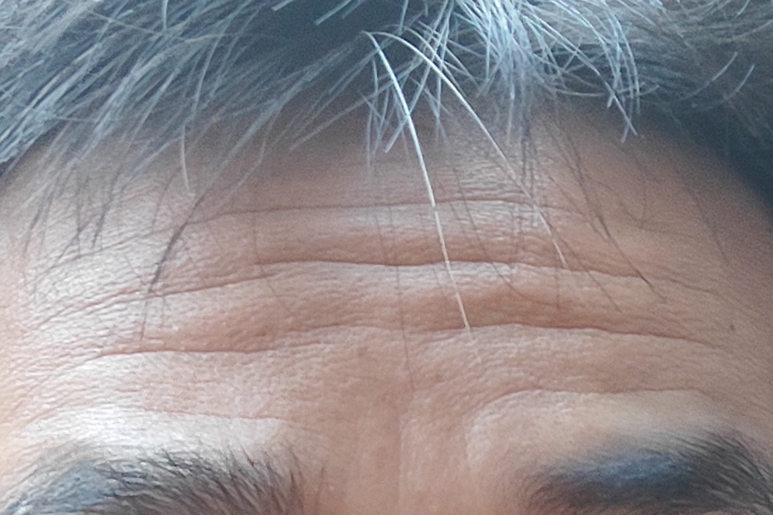 抬头纹是额部皱纹
