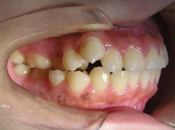  /p> p>正畸拔牙一般可以达到治疗牙齿矫治拥挤,矫