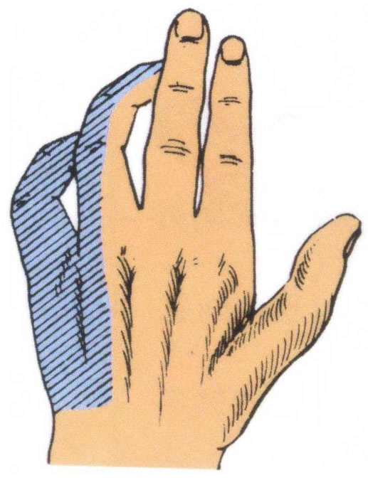  p>爪形手是 a target="_blank" href="/item/尺神经损伤/8842933"