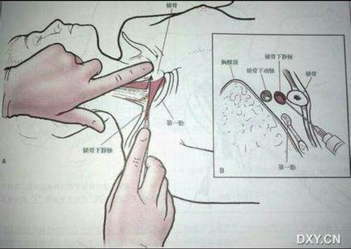 动脉穿刺