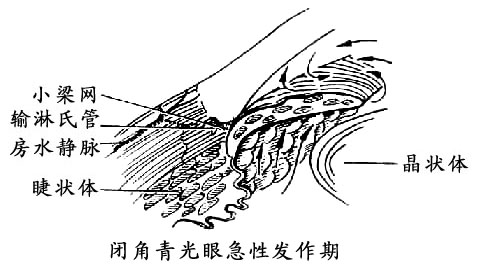 闭角型青光眼