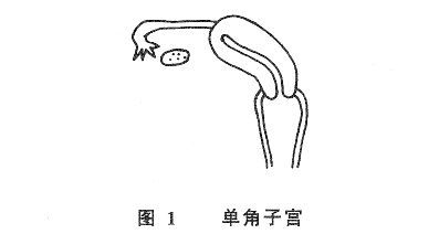 单角或双角子宫_百度百科