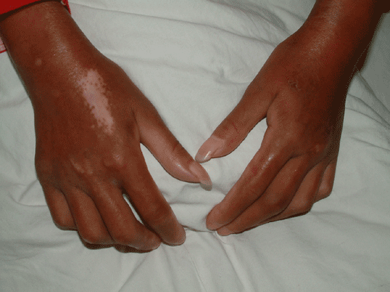  p> a target="_blank" href="/item/肢端硬皮病">肢端硬皮病 /a>有 a