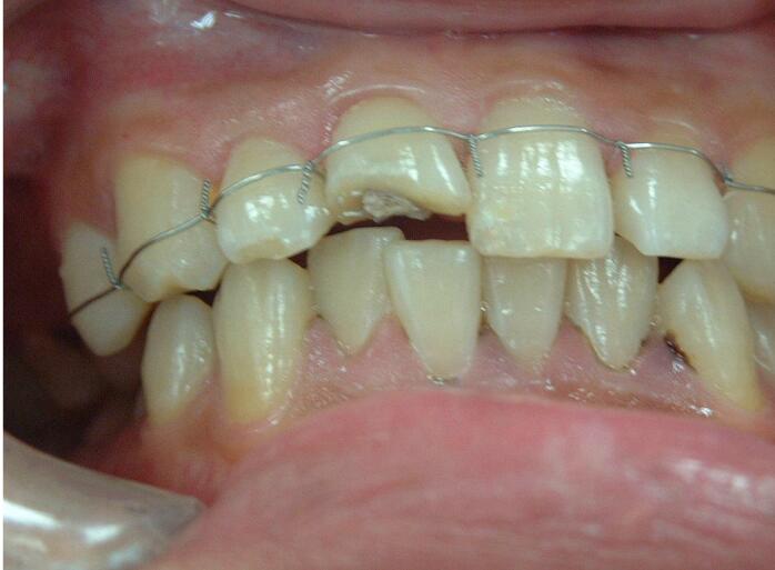 ="/item/牙齿/1454" data-lemmaid="1454">牙齿 /a>通过夹板互相连接