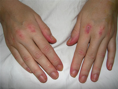  p>皮肌炎(jdm)属于 a href="#" data-lemmaid="1800809">自身免疫性