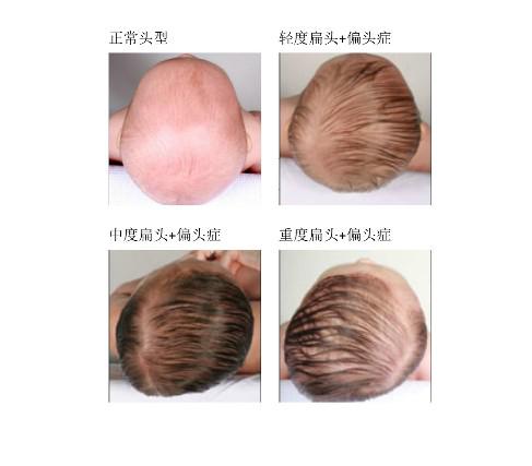 情况下其左右 a href="#" data-lemmaid="111383">头颅 /a>应该是 a