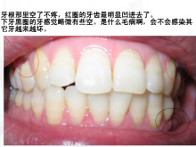 牙龈