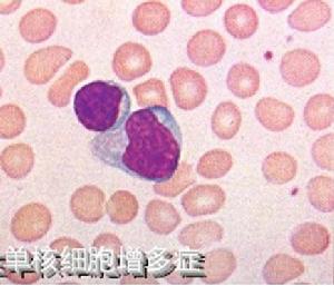 ="/item/细胞">细胞 /a>增多症(infectious mononucleosis)是由ebv a
