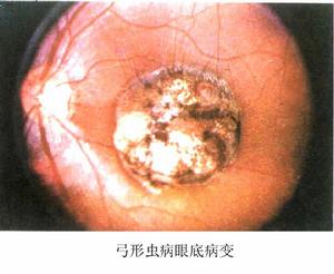 获得性弓形虫病