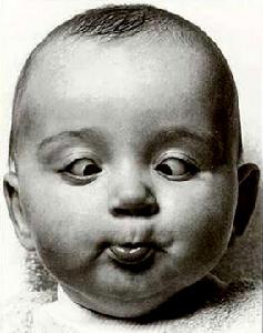 称为斗鸡眼,也叫做 a target="_blank" href="/item/对眼/9277185"