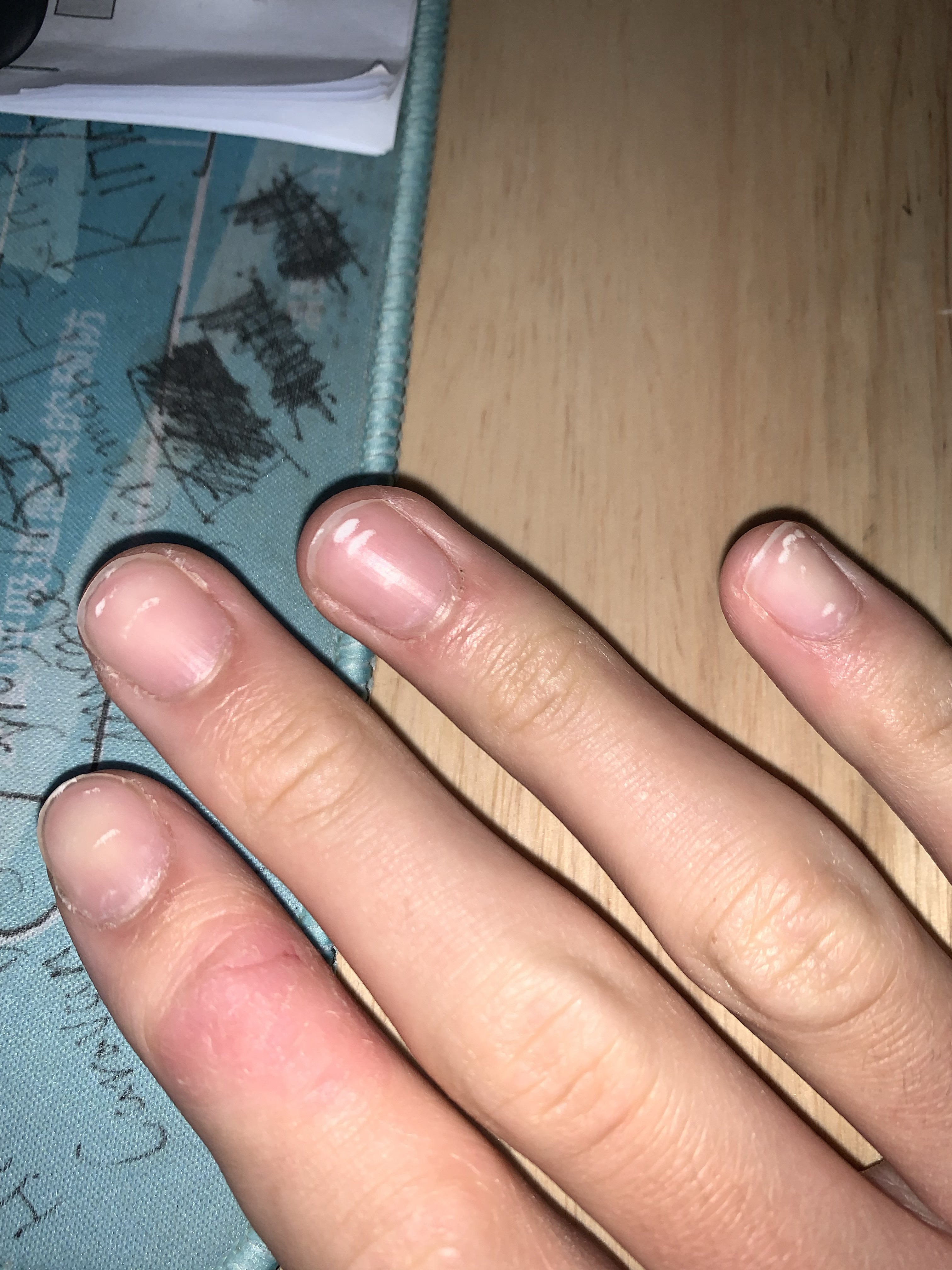 常见的有点状甲白斑病,线状甲白斑病,常发生于甲半月部,随着指甲生长