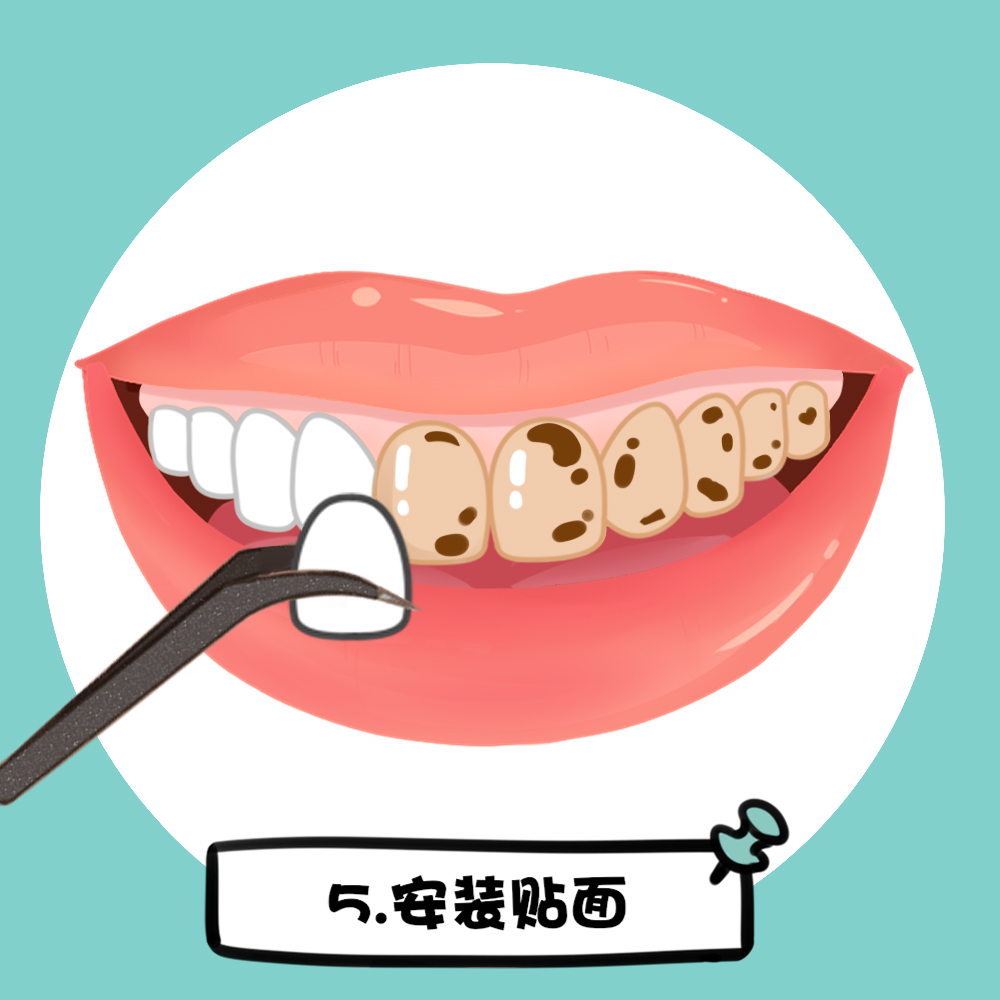 牙齿贴面