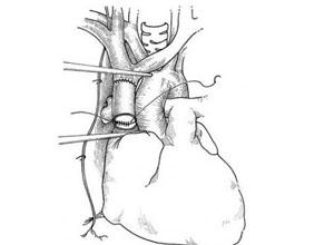  a href="#" data-lemmaid="7518587">上腔静脉阻塞综合征 /a>是由于