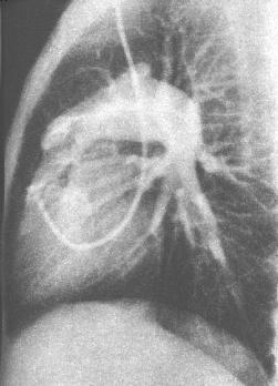  p>肺动脉狭窄作为单发畸形为常见先天性心脏病之一,约占先天性心脏病