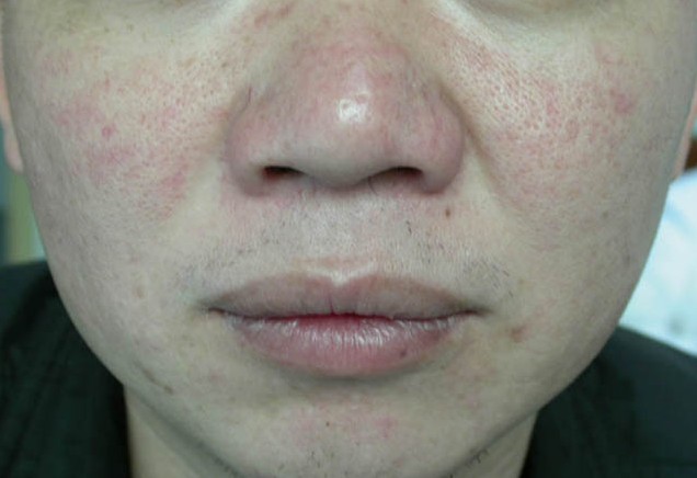 data-lemmaid="8849994">肉眼 /a>就能看见一条条扩张的毛细血管,部分