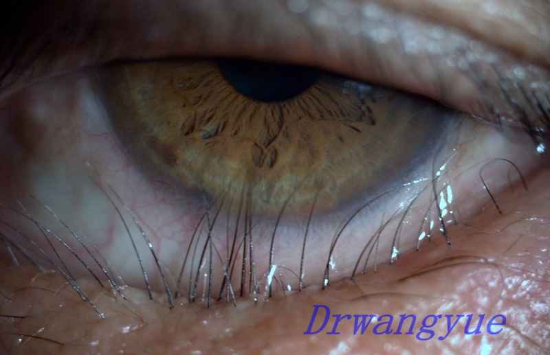  p>倒睫(trichiasis):是指睫毛向后方生长,以致触及眼球的不正常状况.