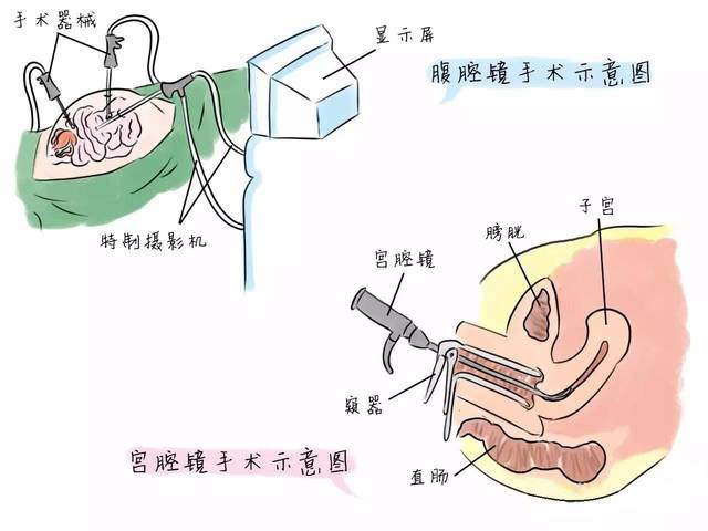  p>宫腔镜手术是指用 a href="#" data-lemmaid="8495816">宫腔镜 /a>
