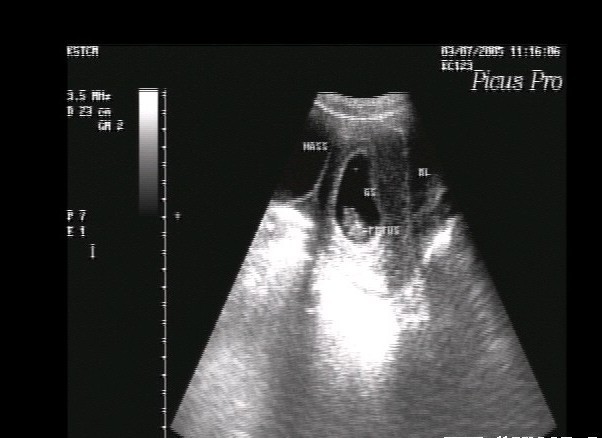 corpus luteum of pregnancy
