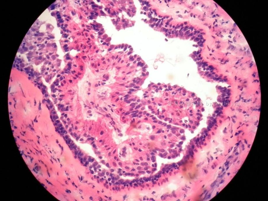 导管内乳头状瘤(口腔医学 名词)导管内乳头状瘤分为乳腺导管内乳头状