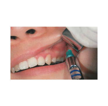 阻滞麻醉,此法是将局 a target="_blank" href="/item/麻药/7623917"