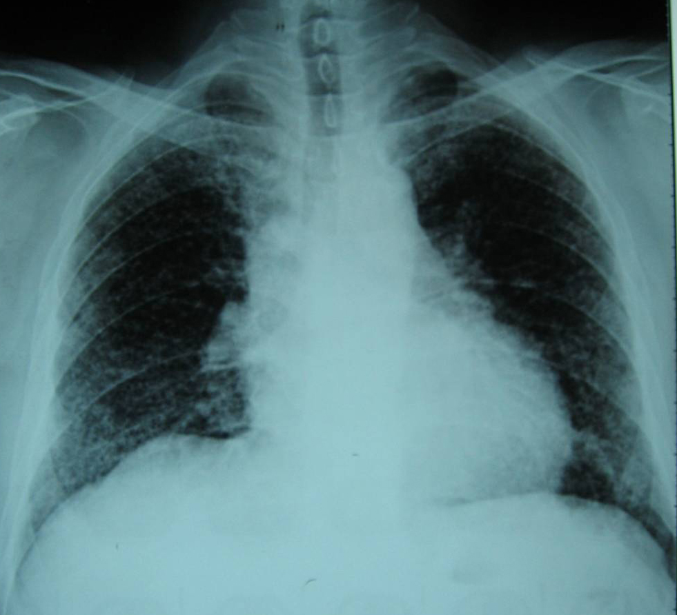 朗格汉斯细胞组织细胞增生症