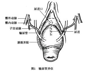 子宫颈外口坐骨棘水平以下甚至子宫全部脱出阴道口外的一种生殖伴邻近