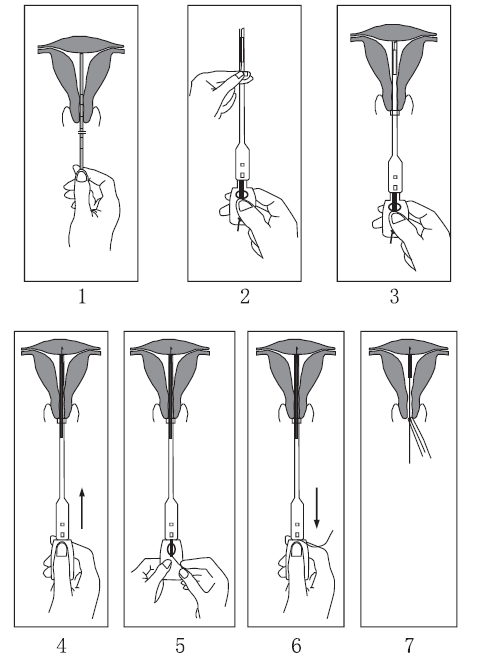 含吲哚美辛硅橡胶的无支架固定式宫内节育器