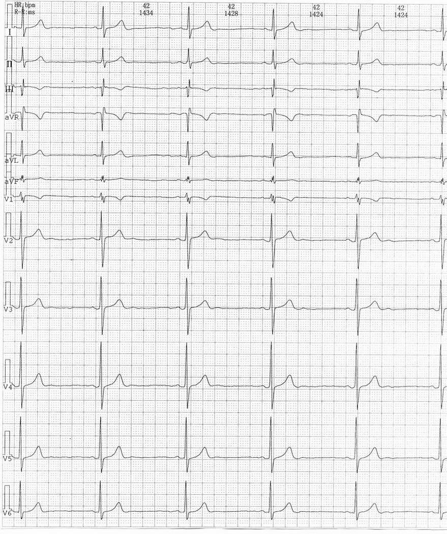  p>窦性心律过缓指如果心电图是窦性,低于60次/分为心律过缓,而正常的