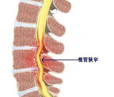 椎管狭窄(spinal stenosis)是各种原因引起椎管各径线缩短,压迫硬膜囊