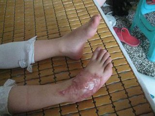  p data-id="gnb732kq3n">马蹄脚又称"马蹄足","垂足","尖足".