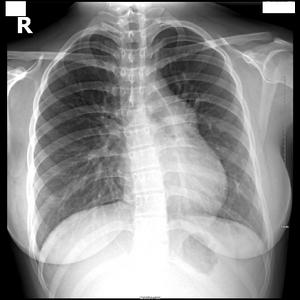  p>原发性肺动脉高压指肺小动脉原发增生性病变所致的闭塞性肺动脉