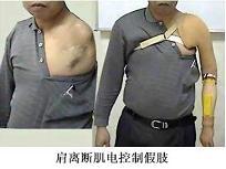 ">关节 /a> /b>离断,上肢带解脱术(肩胛骨和锁骨截肢)及上臂高位截肢