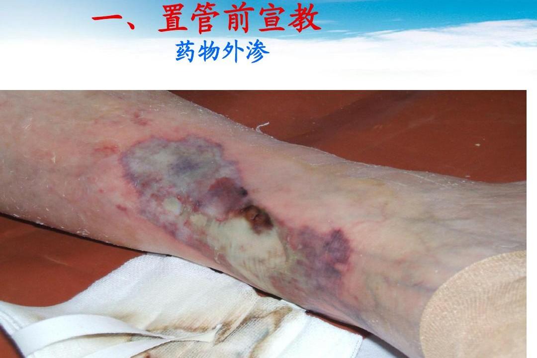 药物外渗
