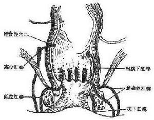 malformation inborn)多见,并且类型众多,直肠盲端和瘘管的位置各异